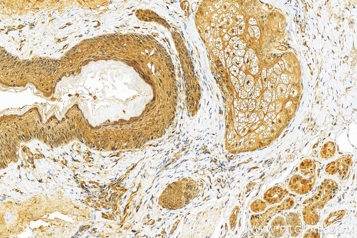 IHC staining of human skin cancer using 22632-1-AP