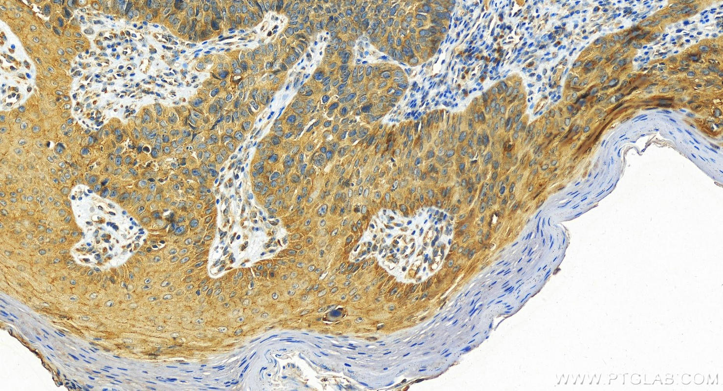 IHC staining of human bowen disease using 18338-1-AP