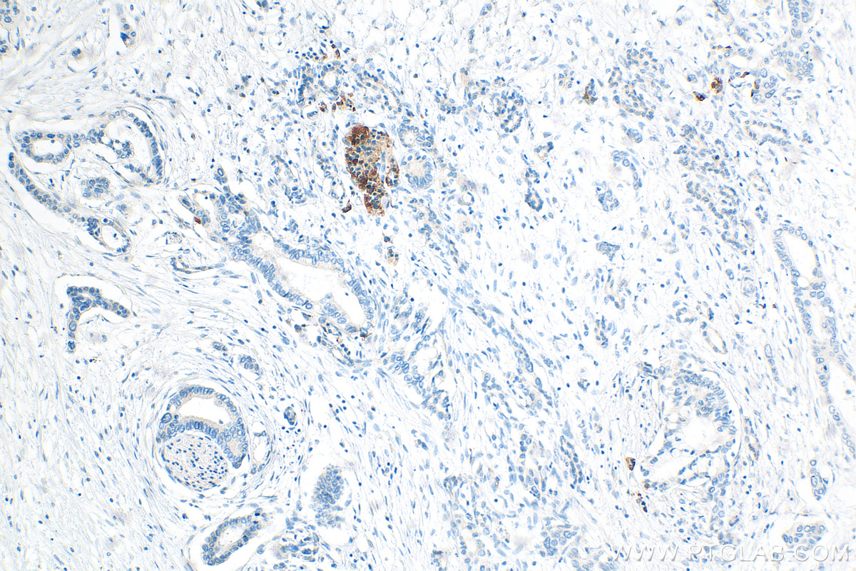 IHC staining of human pancreas cancer using 15843-1-AP