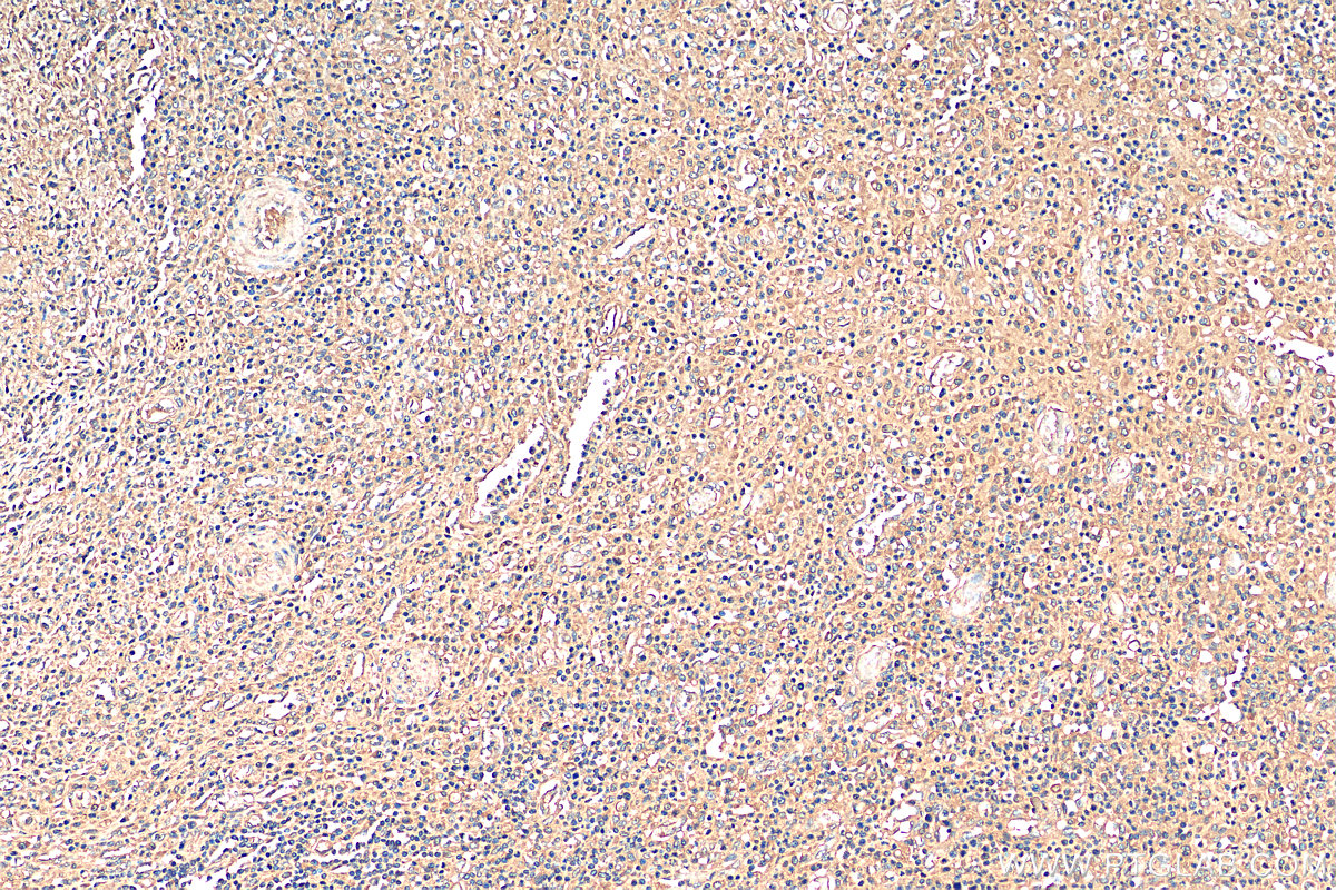 IHC staining of human colon cancer using 28924-1-AP