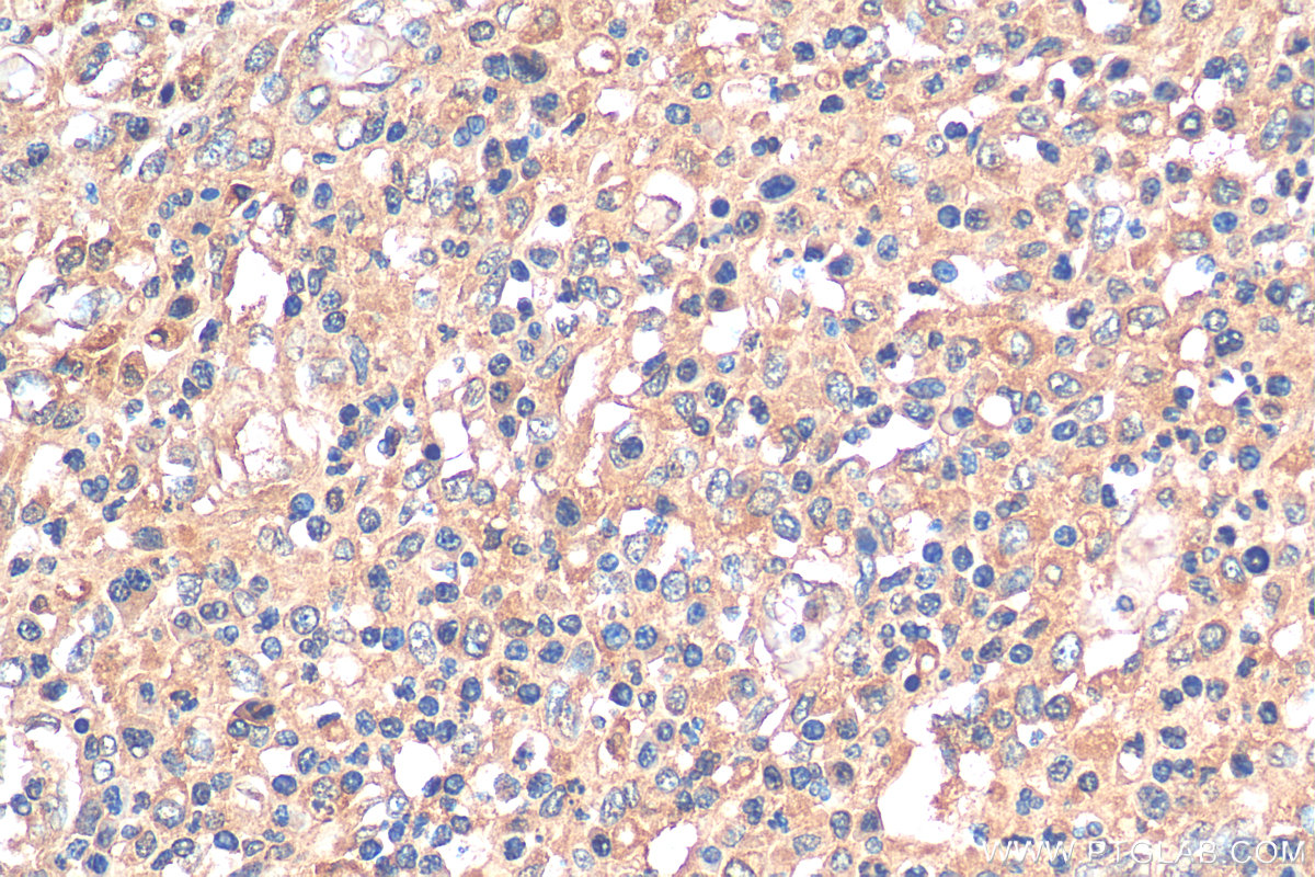 IHC staining of human colon cancer using 28924-1-AP