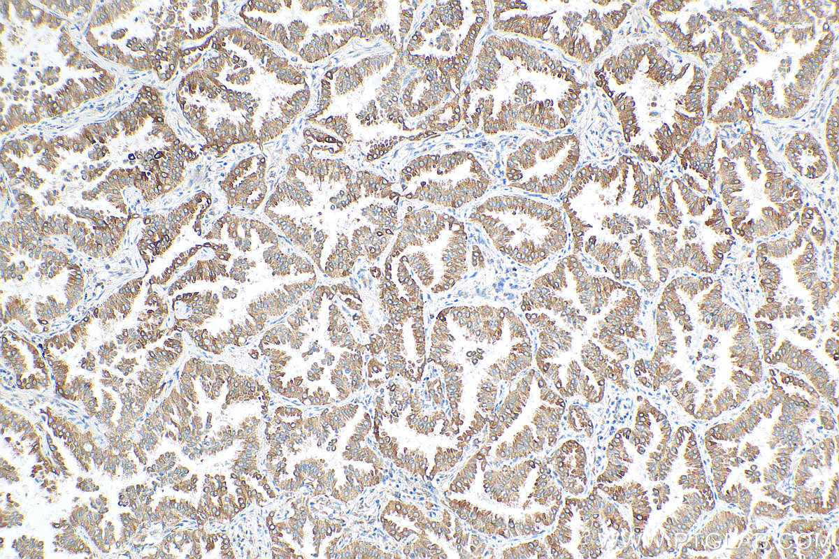 IHC staining of human lung cancer using 68133-1-Ig