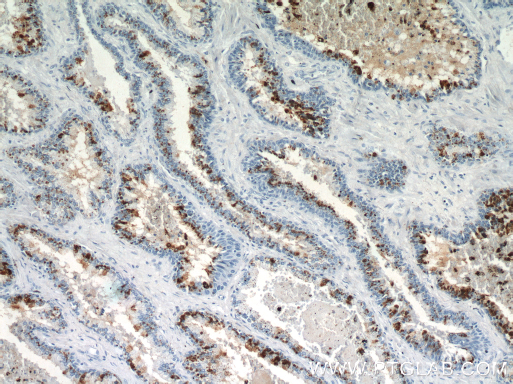 IHC staining of human prostate hyperplasia using 21411-1-AP