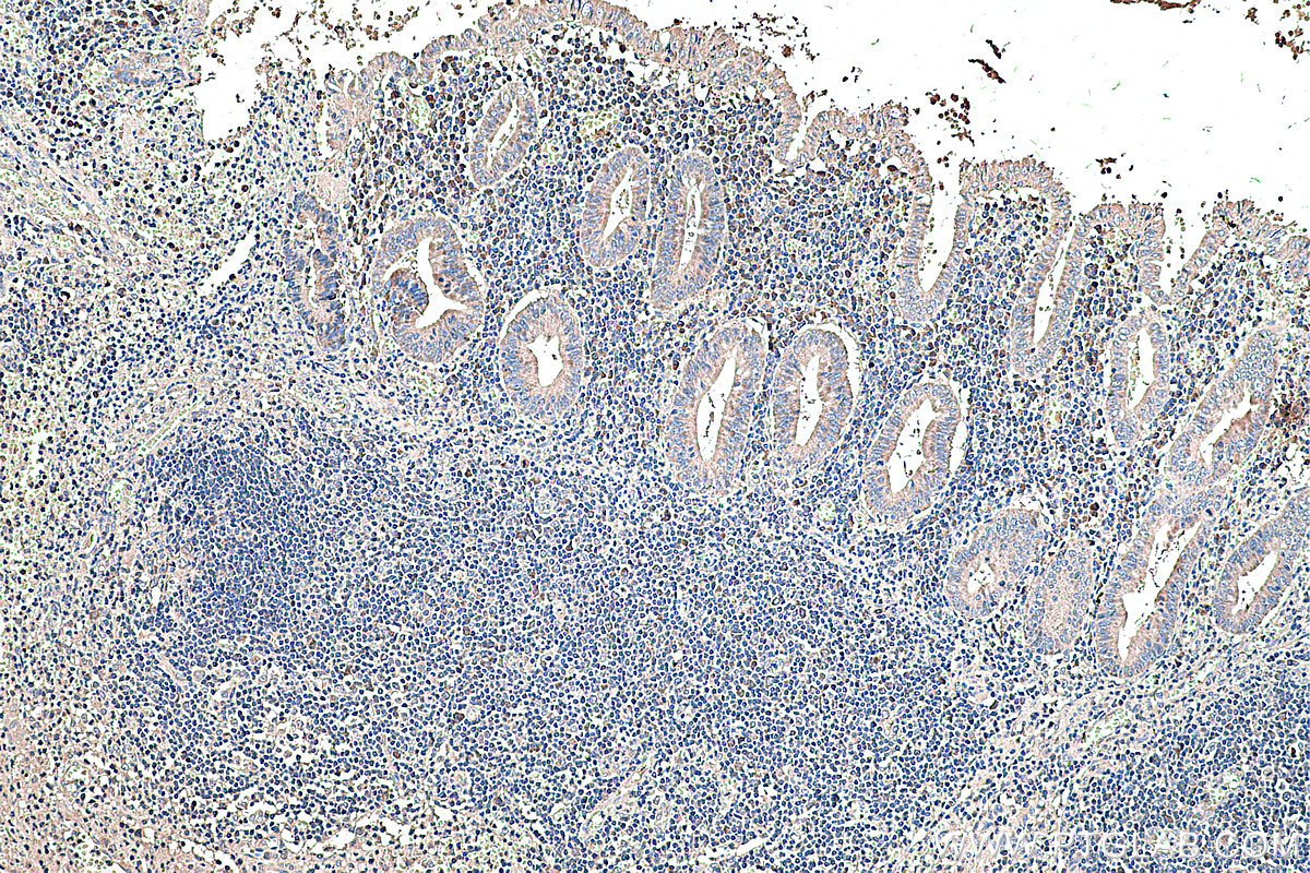 IHC staining of human appendicitis using 60294-1-Ig (same clone as 60294-1-PBS)