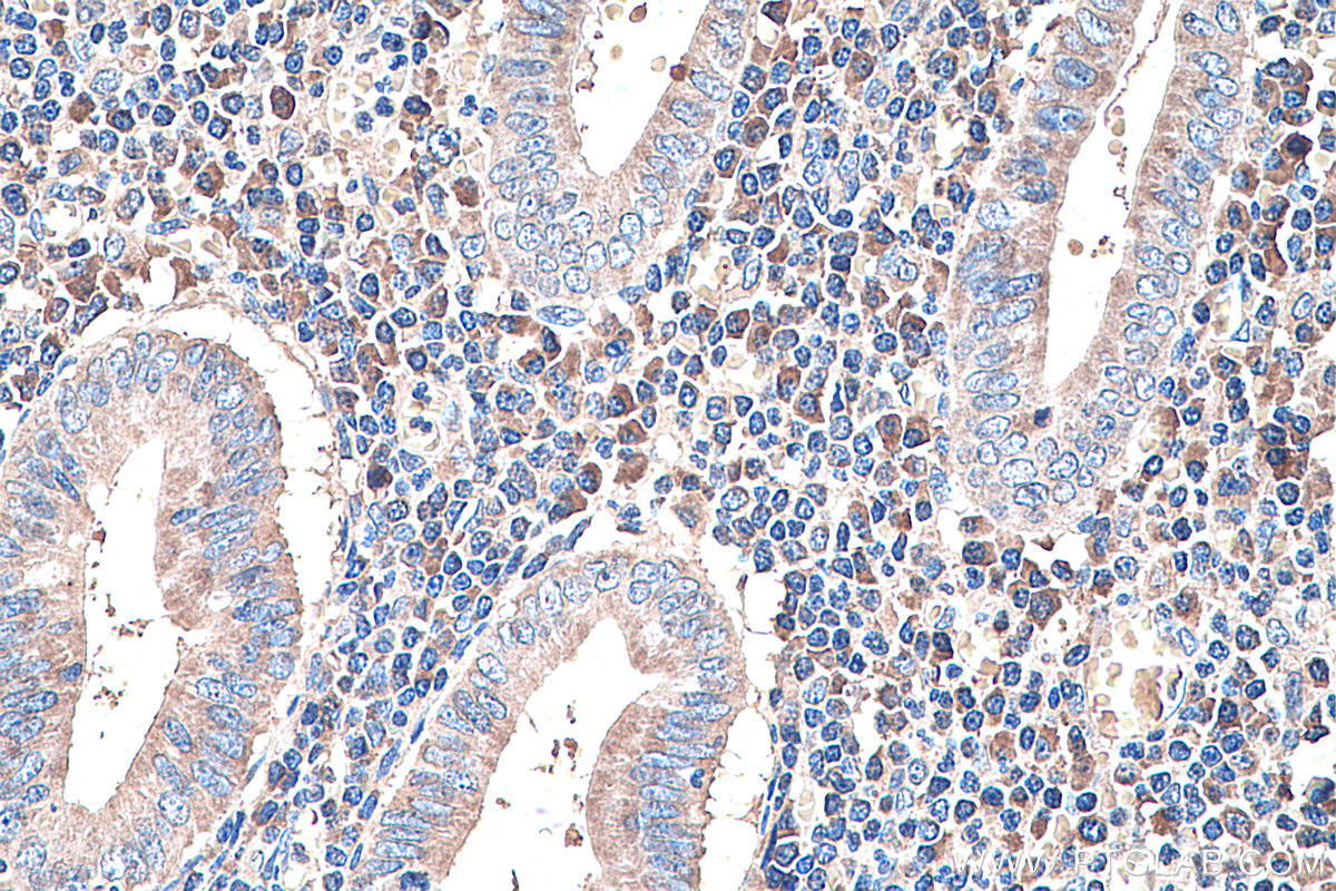 IHC staining of human appendicitis using 60294-1-Ig (same clone as 60294-1-PBS)