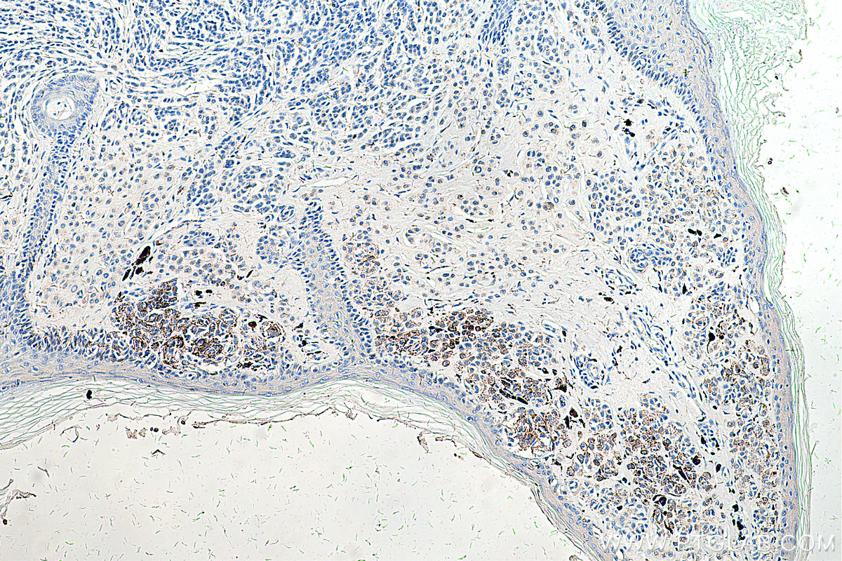 IHC staining of human malignant melanoma using 60294-1-Ig (same clone as 60294-1-PBS)