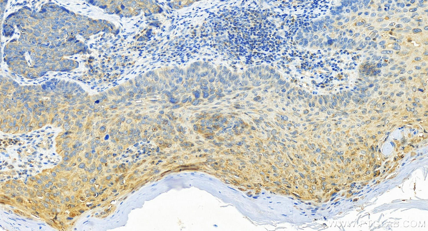 IHC staining of human bowen disease using 17968-1-AP