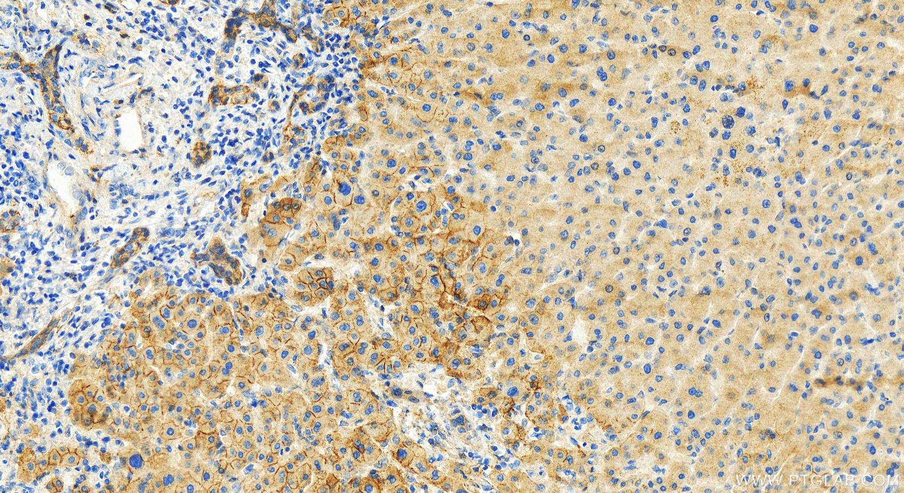 IHC staining of human intrahepatic cholangiocarcinoma using 16792-1-AP