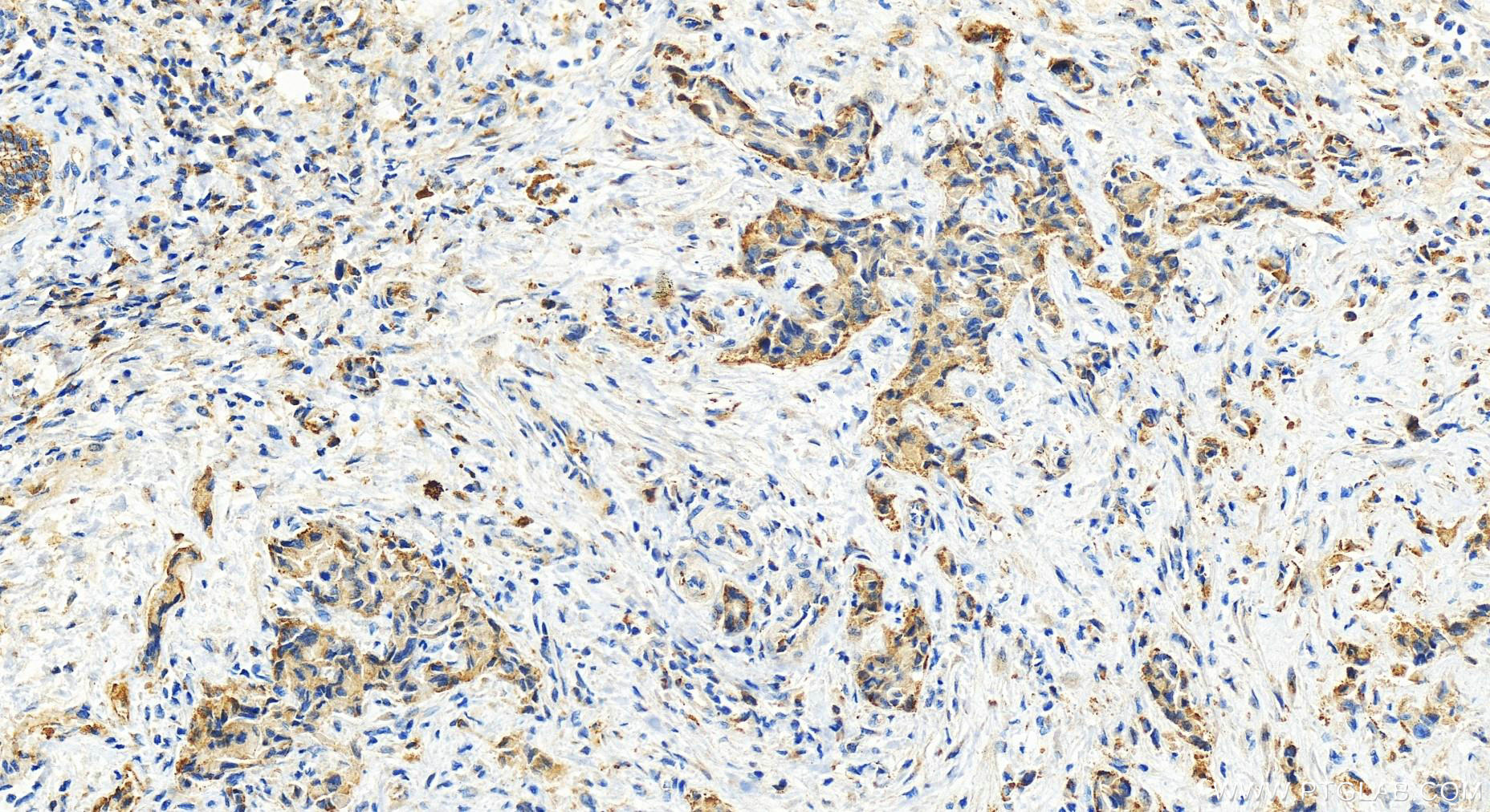 IHC staining of human intrahepatic cholangiocarcinoma using 16792-1-AP