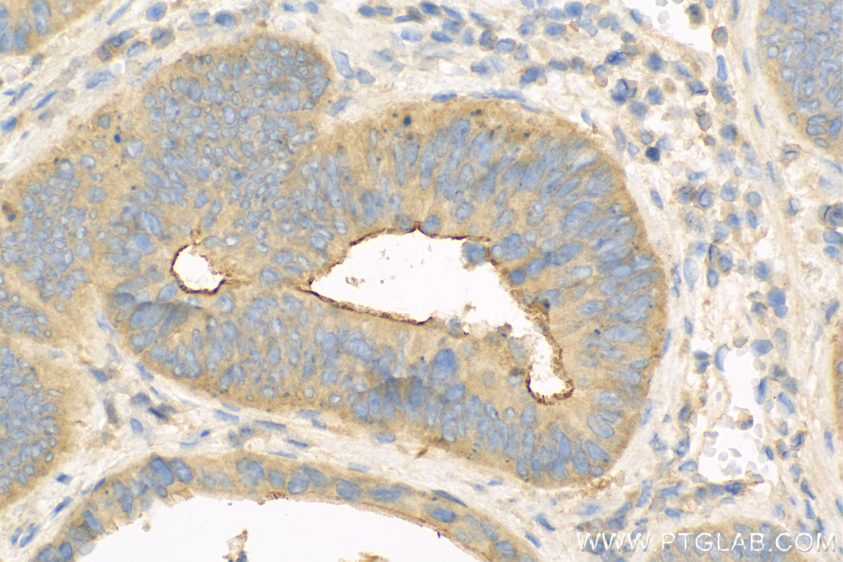 IHC staining of Human Colon cancer using 13143-1-AP