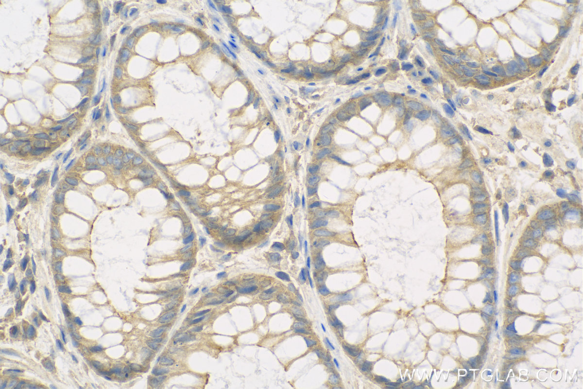 IHC staining of Human Colon cancer using 13143-1-AP (same clone as 13143-1-PBS)