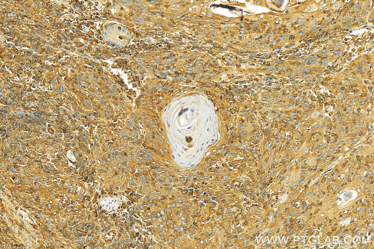 IHC staining of human skin cancer using 12917-1-AP