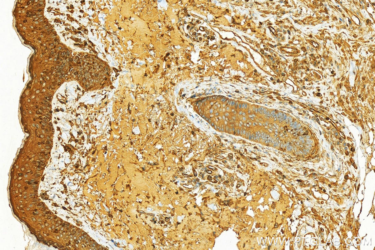 IHC staining of human skin cancer using 12917-1-AP