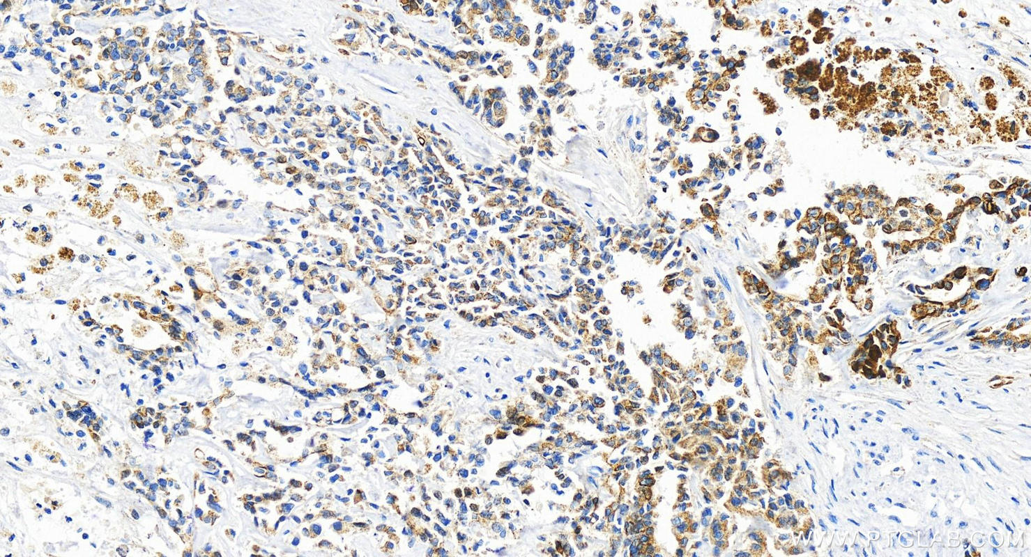 IHC staining of human intrahepatic cholangiocarcinoma using 83449-4-RR (same clone as 83449-4-PBS)