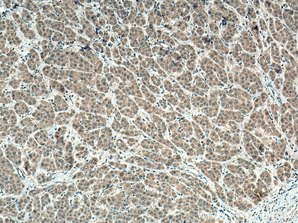 IHC staining of human liver cancer using 11252-2-AP