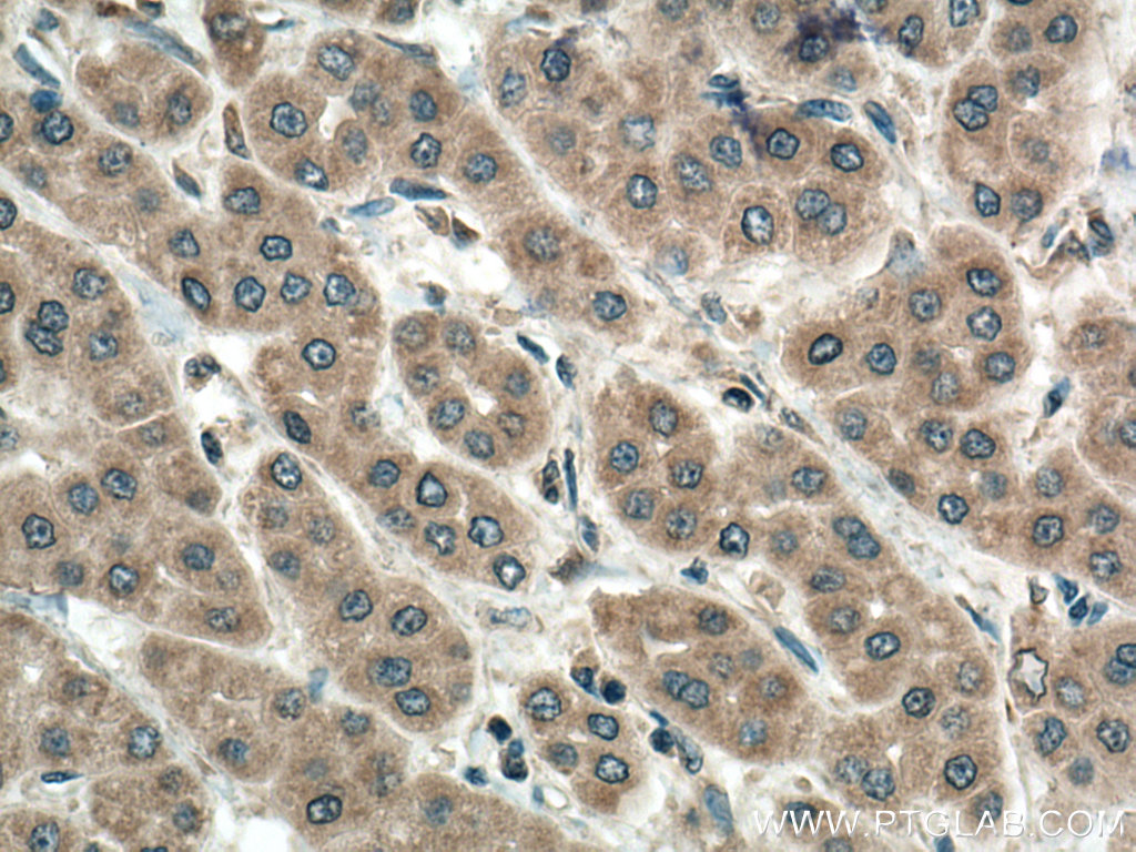 IHC staining of human liver cancer using 11252-2-AP