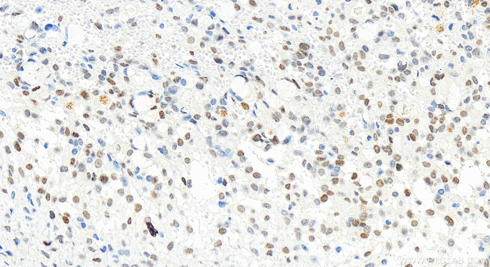 IHC staining of human ovary cancer using 83456-6-RR