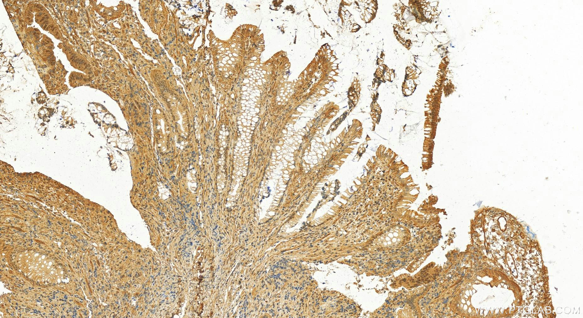 IHC staining of human colon  cancer using 18164-1-AP