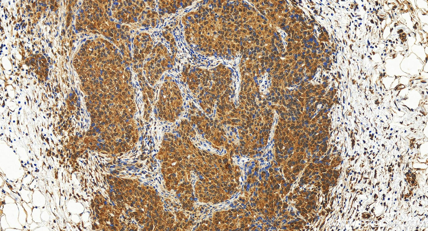 IHC staining of human ovary cancer using 18164-1-AP