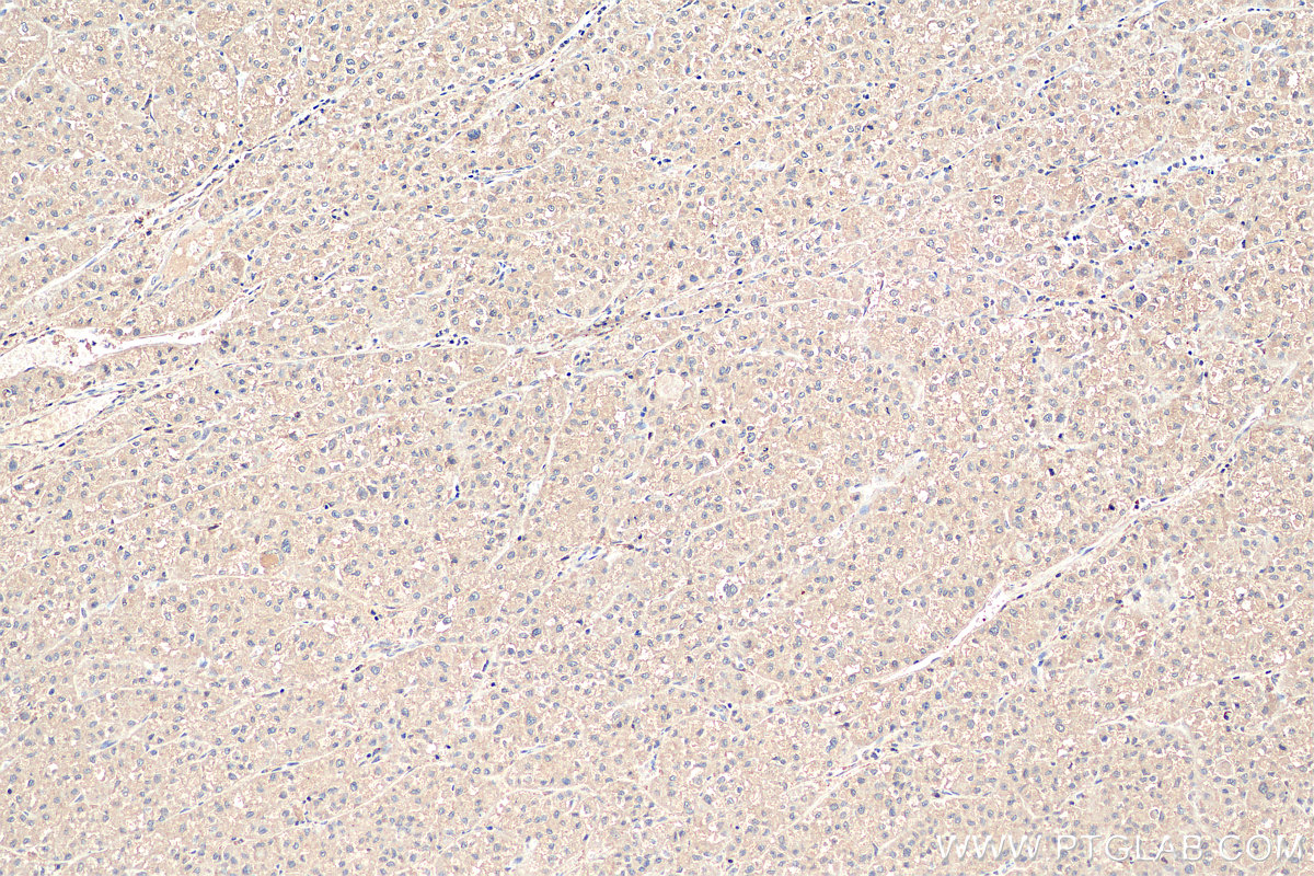 IHC staining of human liver cancer using 11442-1-AP