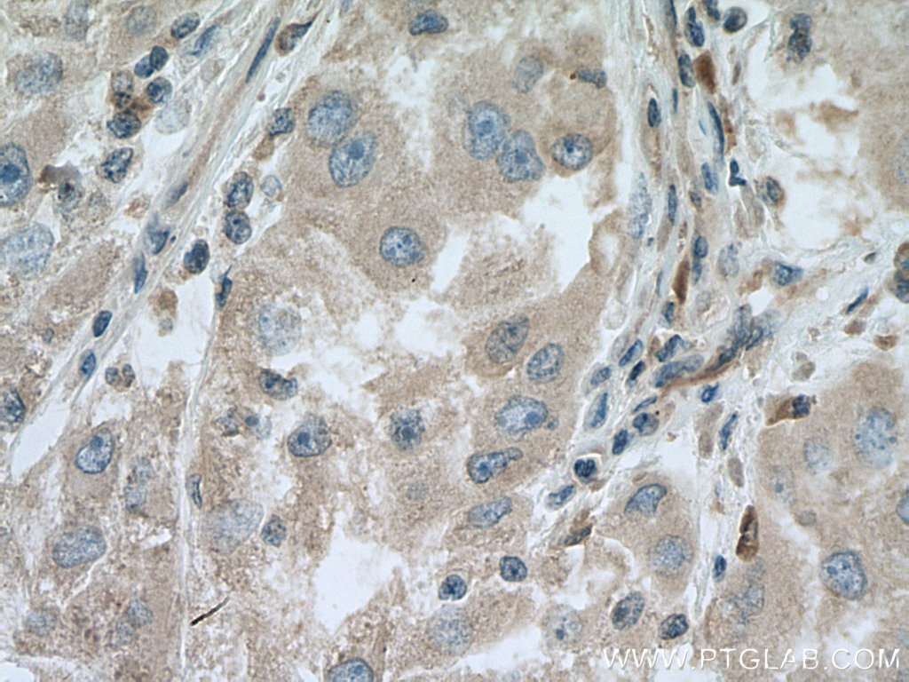 IHC staining of human liver cancer using 67369-1-Ig