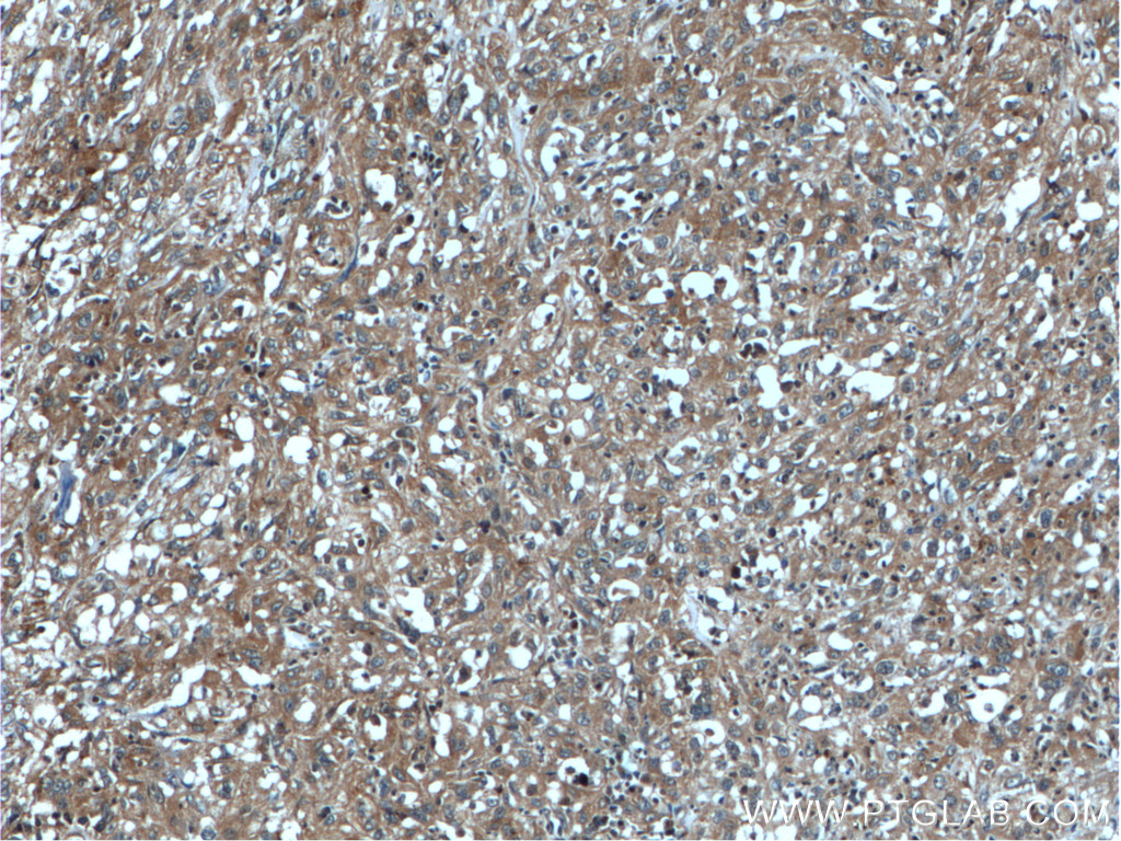 IHC staining of human cervical cancer using 25469-1-AP (same clone as 25469-1-PBS)