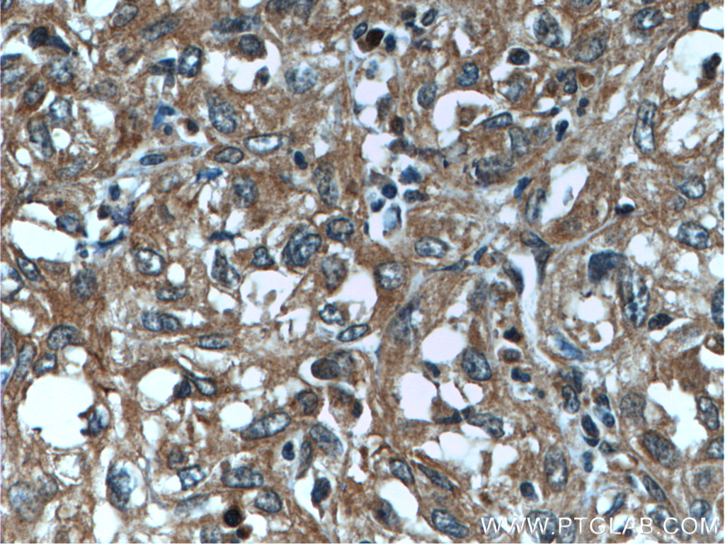 IHC staining of human cervical cancer using 25469-1-AP (same clone as 25469-1-PBS)