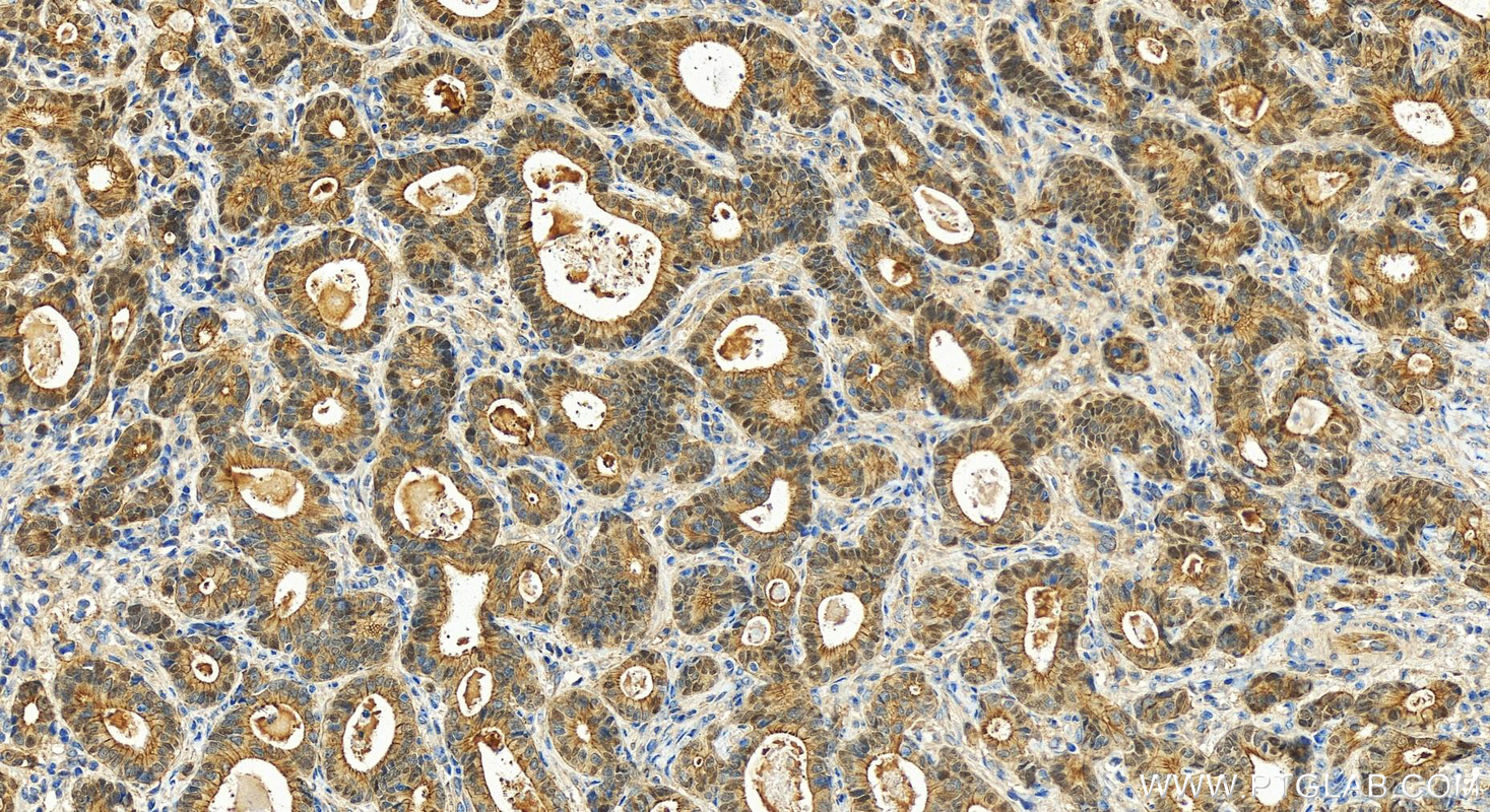 IHC staining of human stomach cancer using 11398-1-AP