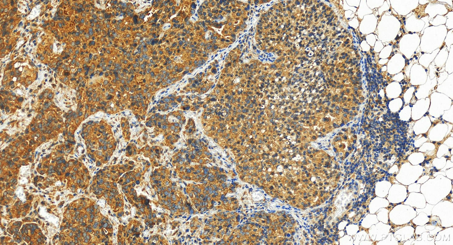 IHC staining of human ovary cancer using 11398-1-AP