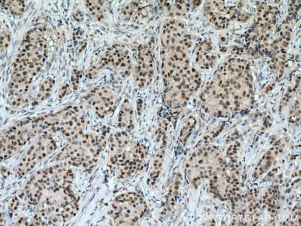 IHC staining of human breast cancer using 15646-1-AP