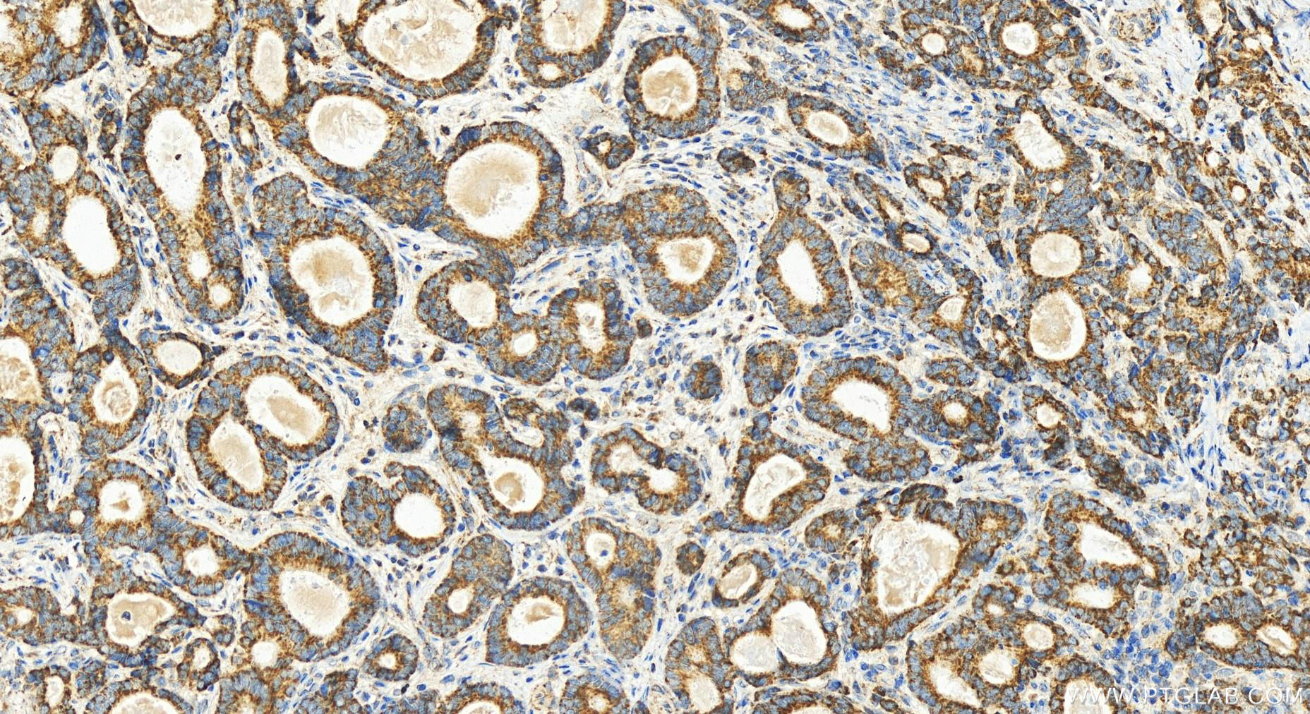 IHC staining of human stomach cancer using 15080-1-AP