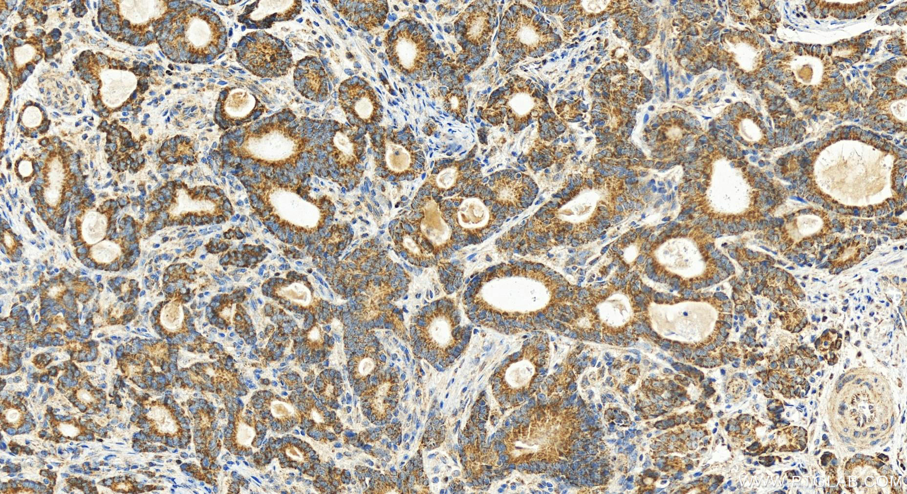 IHC staining of human stomach cancer using 15080-1-AP