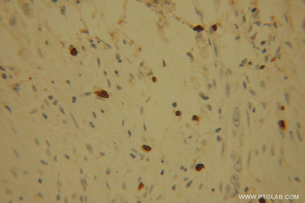 IHC staining of human pancreas cancer using 13635-1-AP