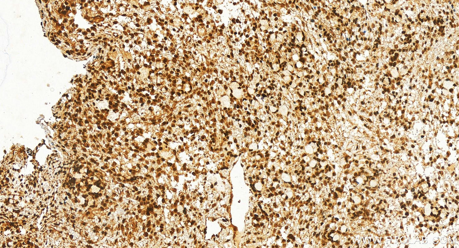 IHC staining of human ovary cancer using 16678-1-AP