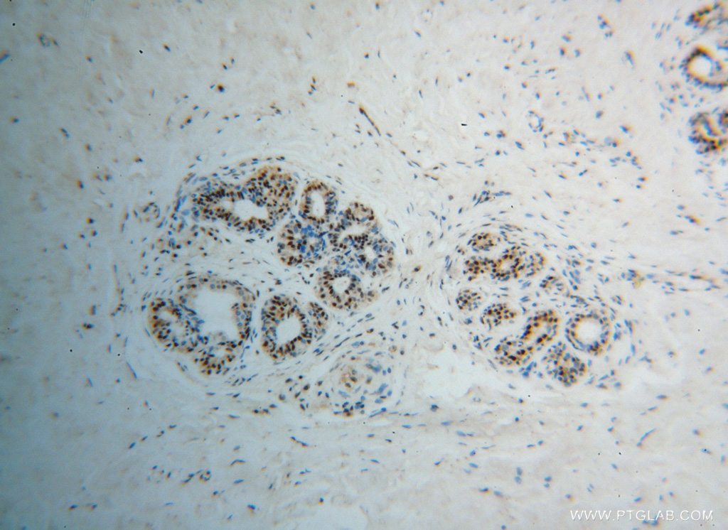 IHC staining of human breast cancer using 15086-1-AP