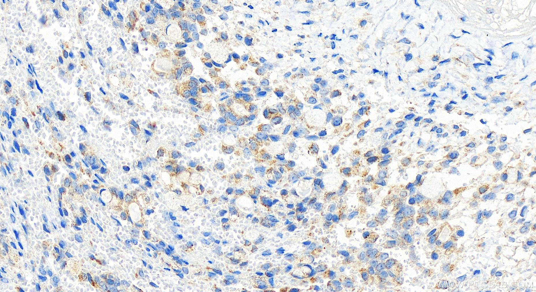 IHC staining of human ovary cancer using 17748-1-AP