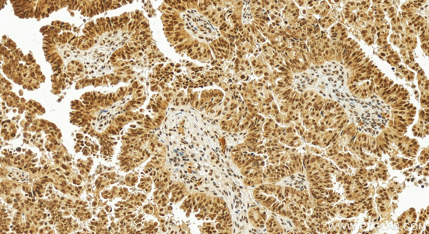 IHC staining of human ovary cancer using 12029-1-AP