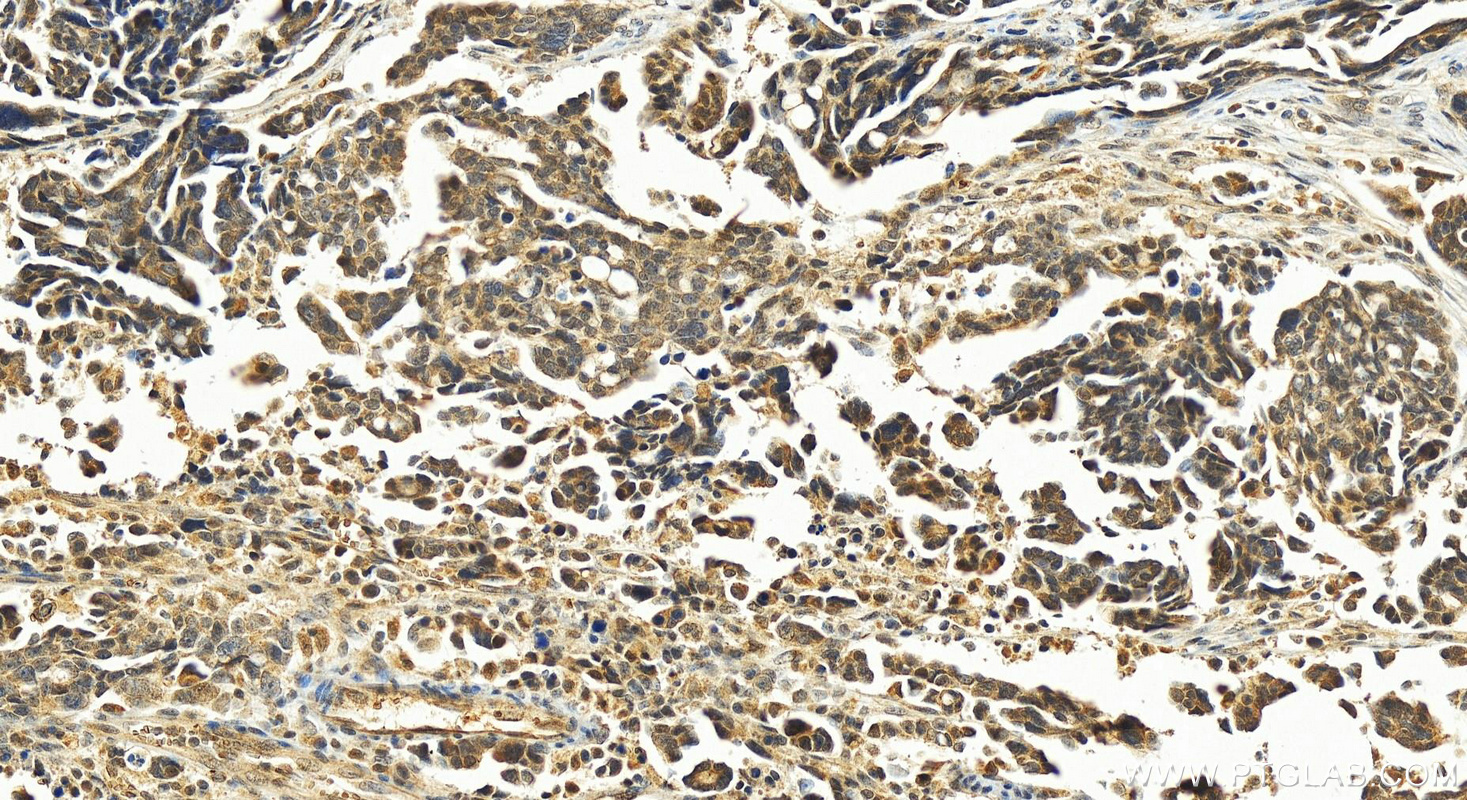 IHC staining of human ovary cancer using 24593-1-AP