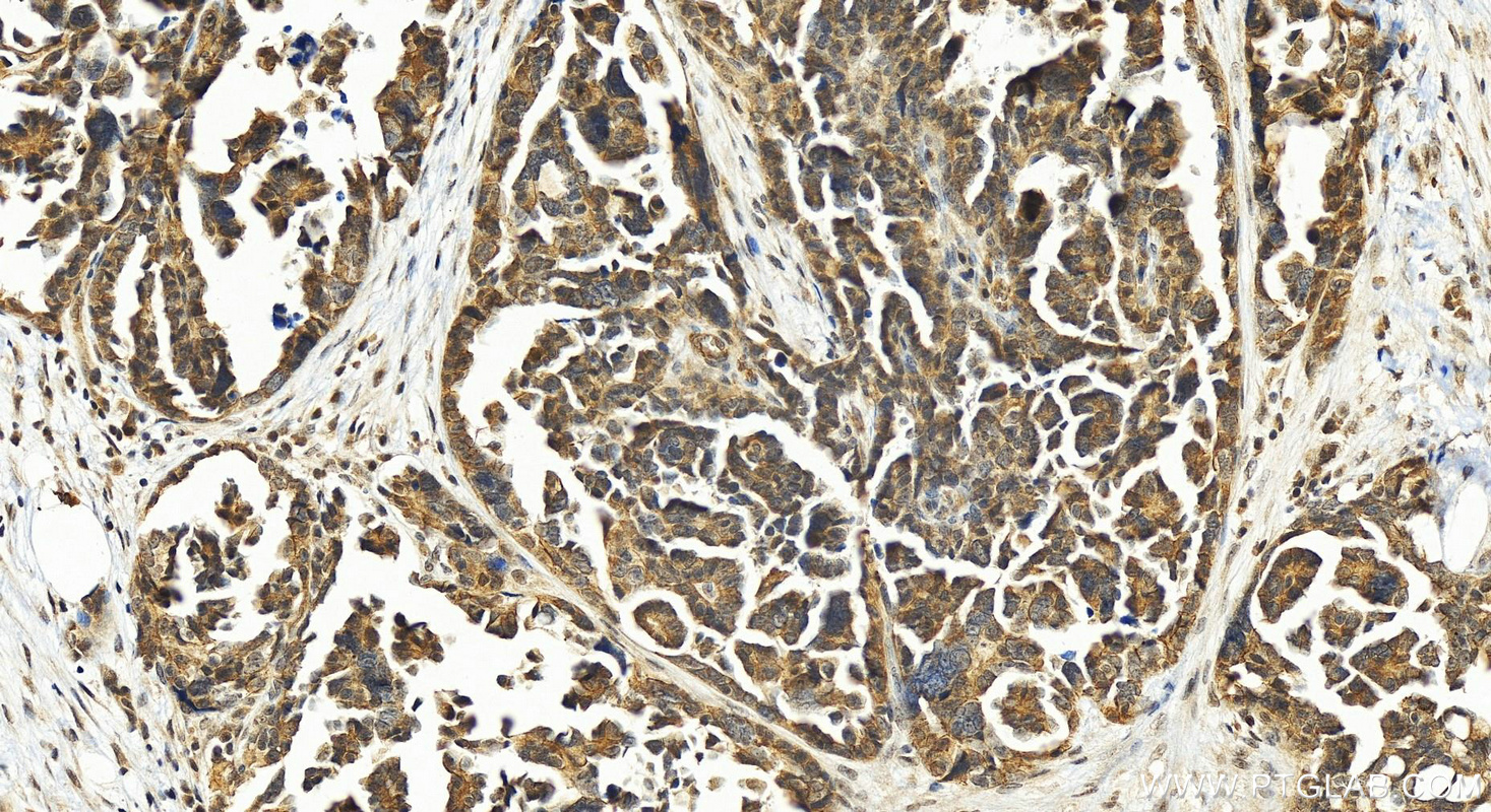 IHC staining of human ovary cancer using 24593-1-AP