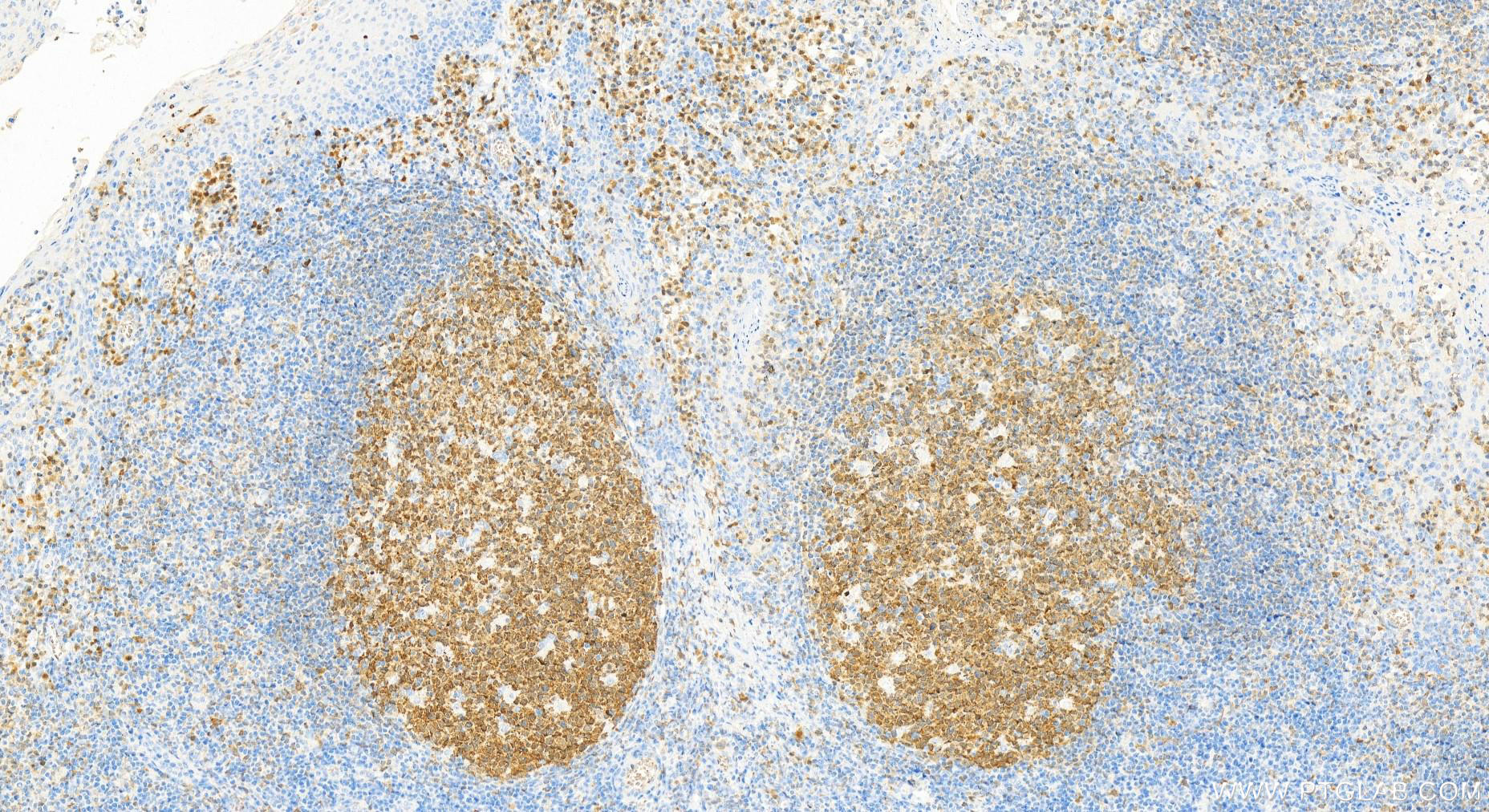 IHC staining of Human tonsillitis using 66659-1-Ig