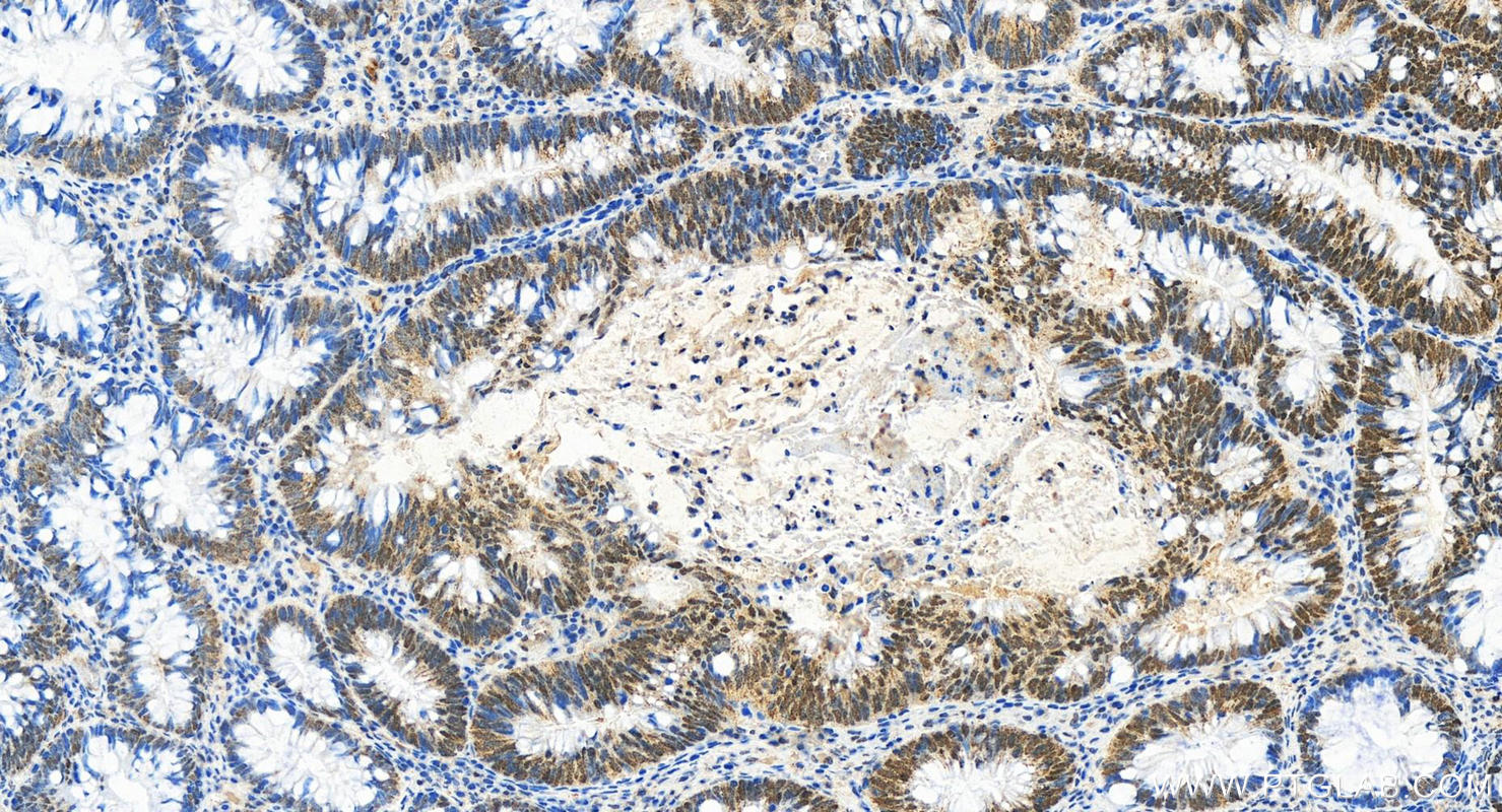 IHC staining of human colon cancer using 10387-1-AP