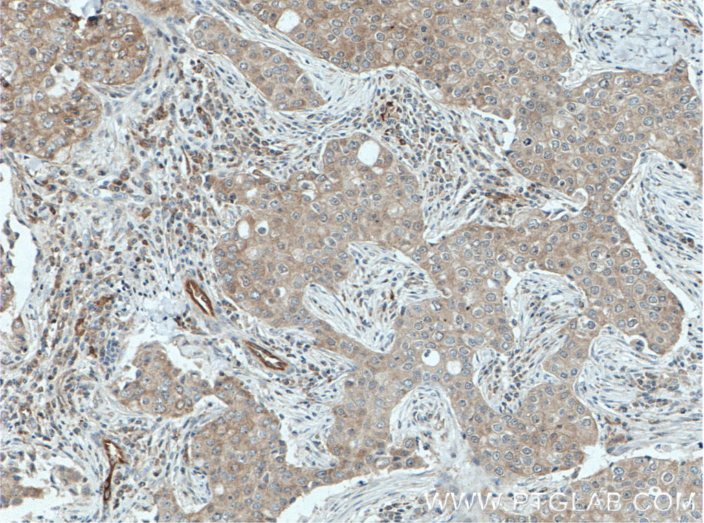 IHC staining of human breast cancer using 14985-1-AP