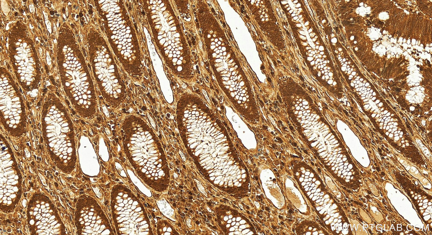 IHC staining of human colon cancer using 16643-1-AP