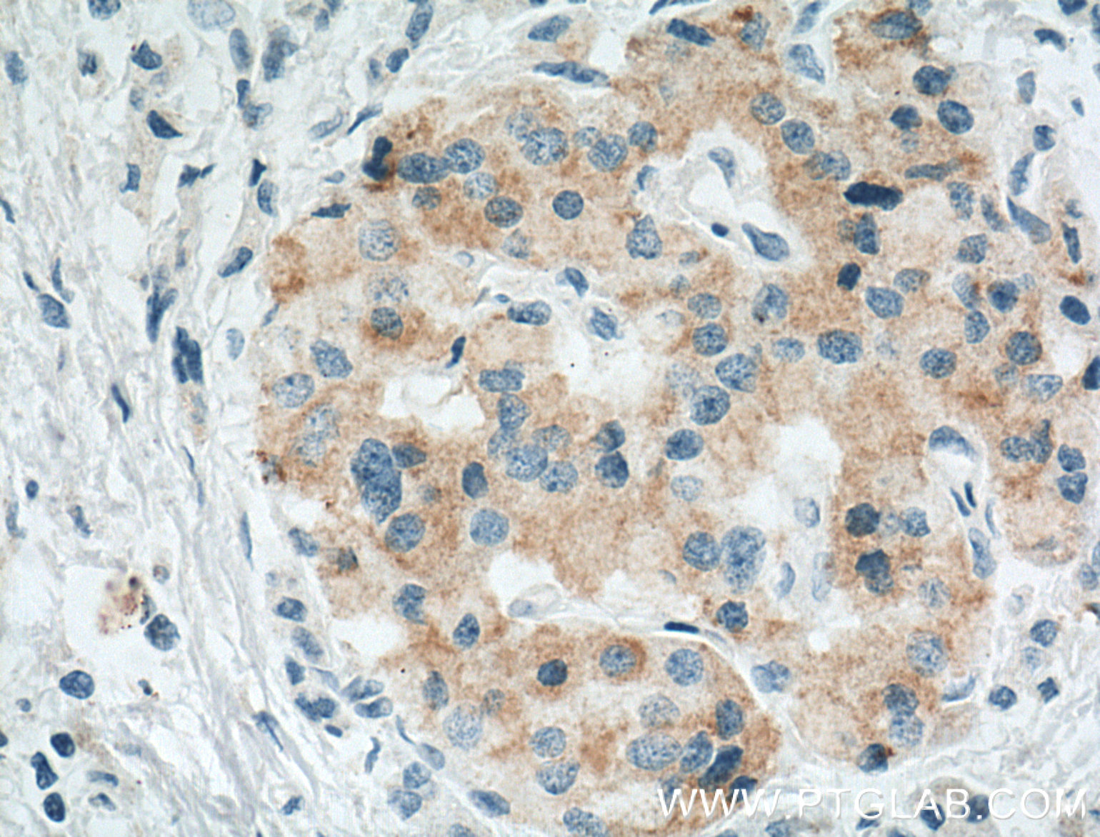IHC staining of human pancreas cancer using 66047-1-Ig (same clone as 66047-1-PBS)