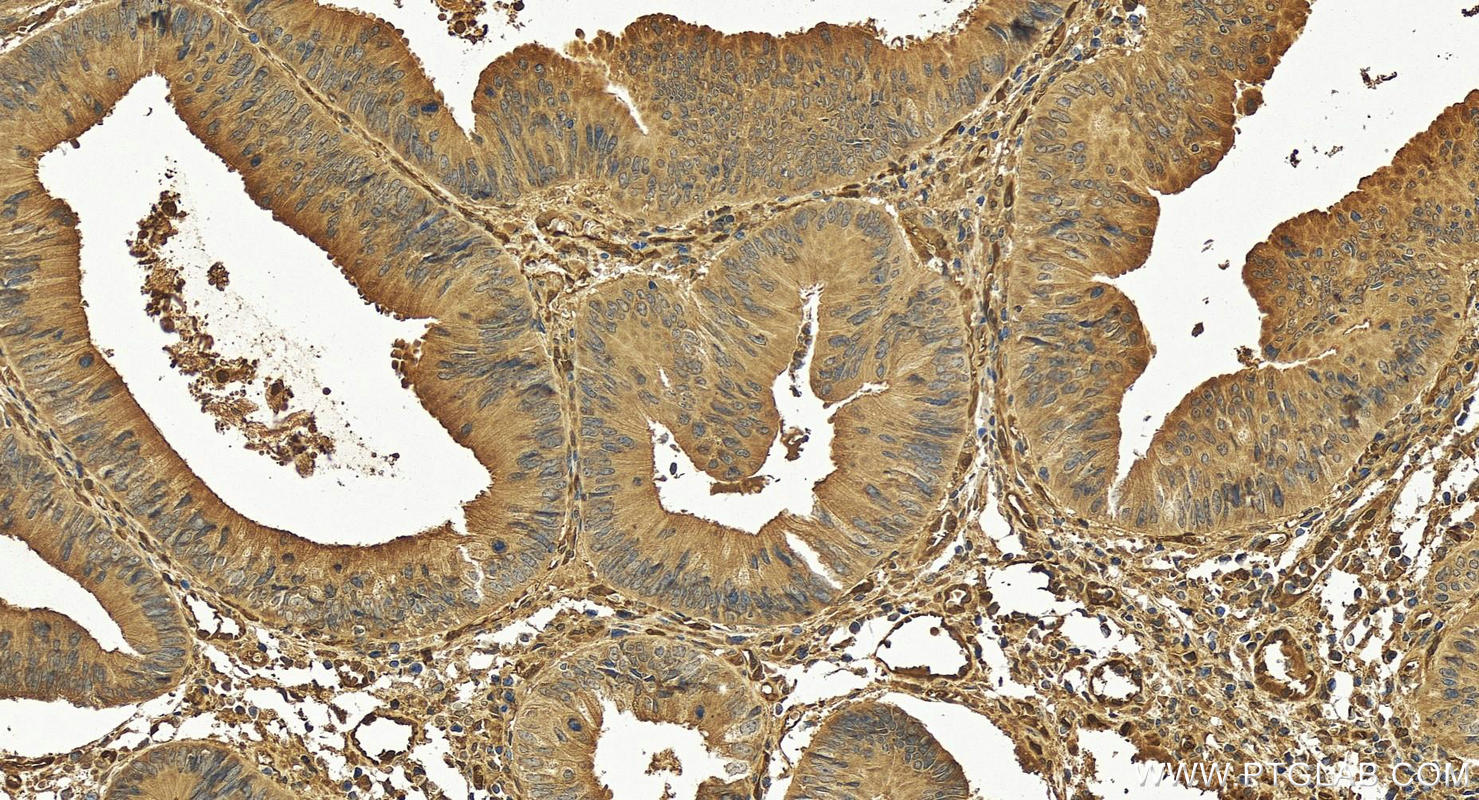 IHC staining of human colon cancer using 17020-1-AP