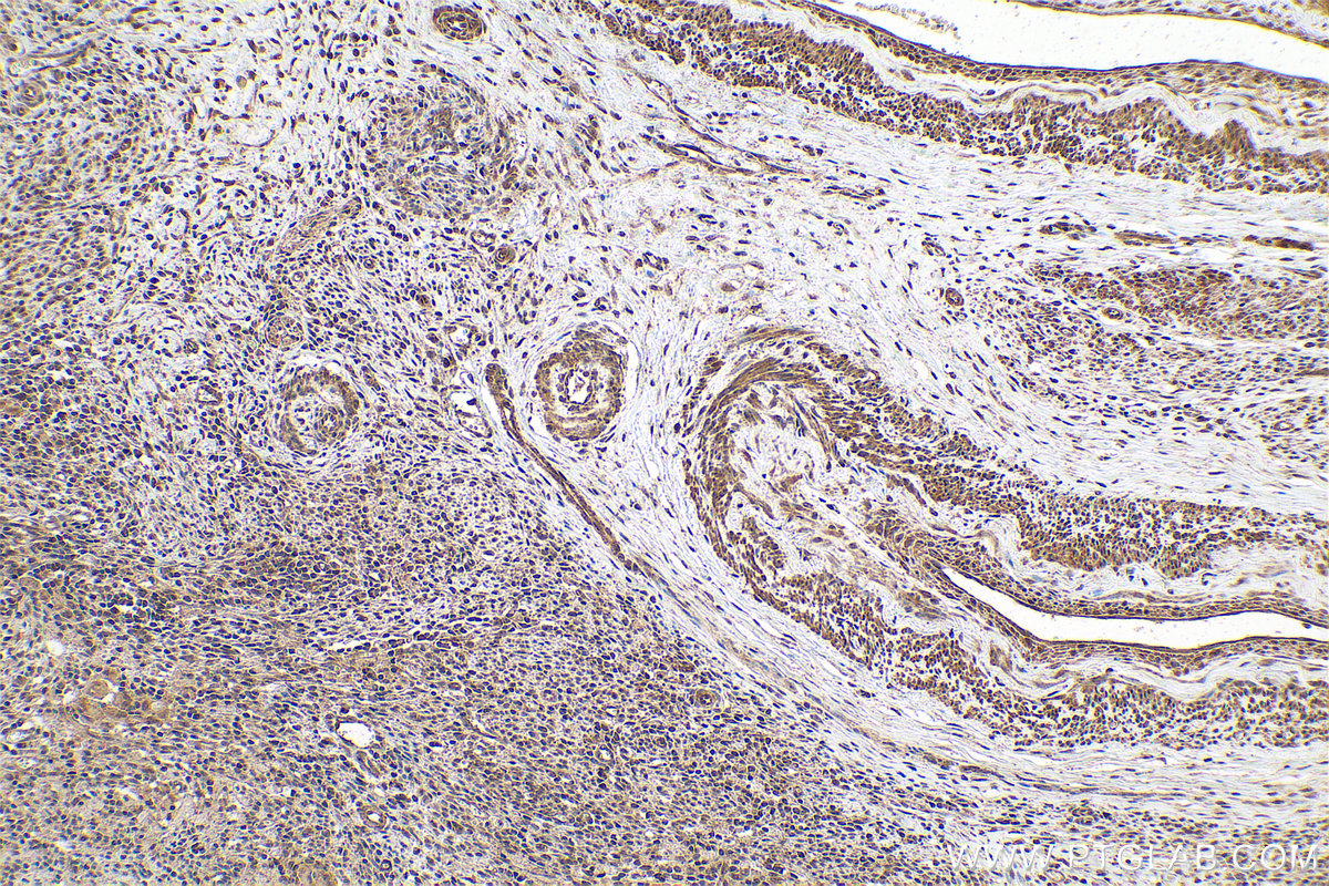 IHC staining of human cervical cancer using 10140-2-AP