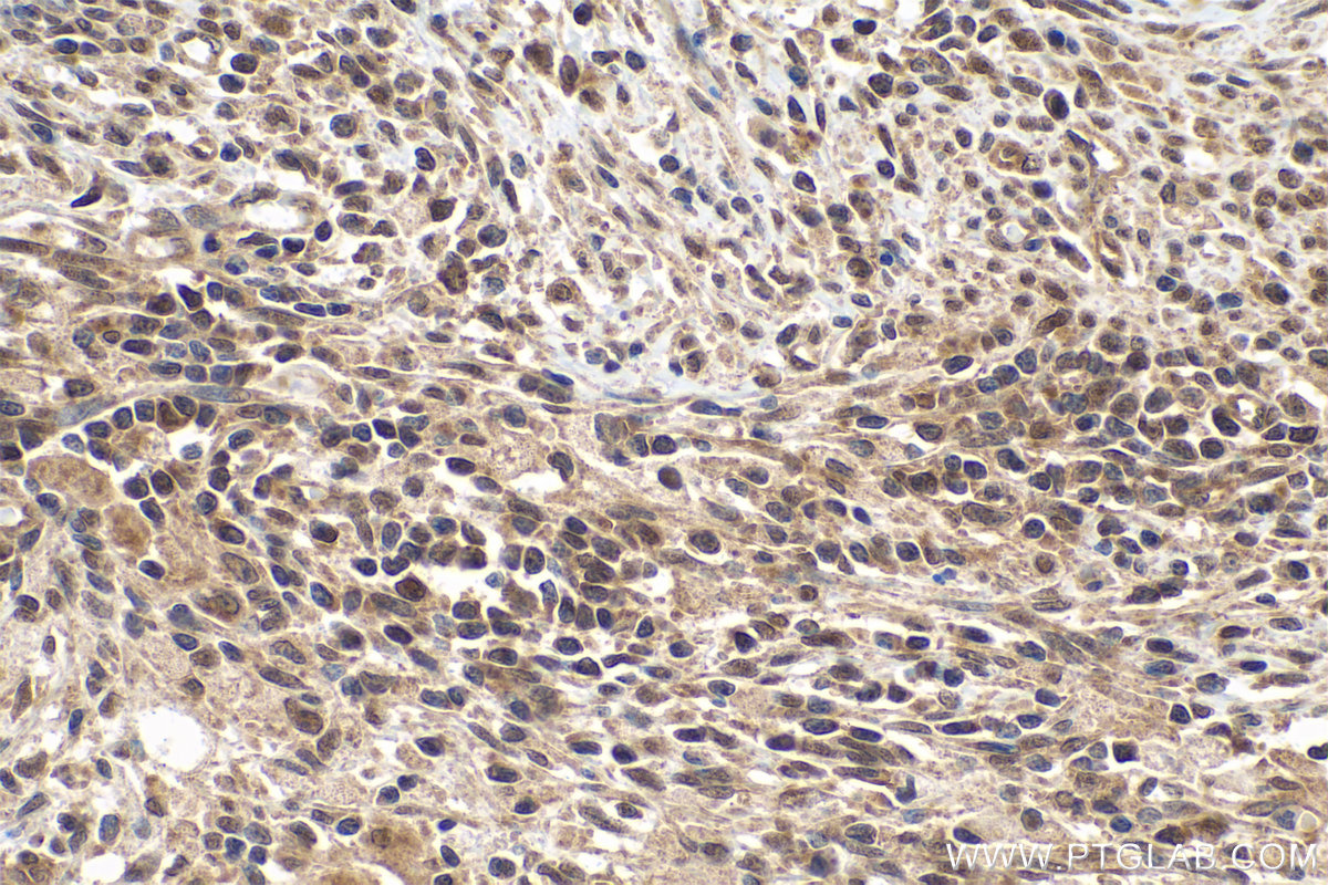 IHC staining of human cervical cancer using 10140-2-AP