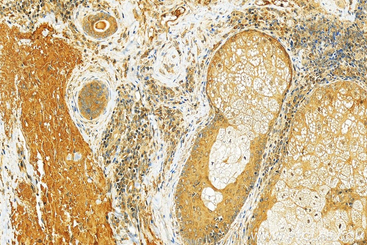 IHC staining of human skin cancer using 55136-1-AP