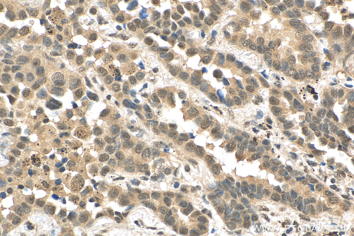 IHC staining of human lung cancer using 29804-1-AP