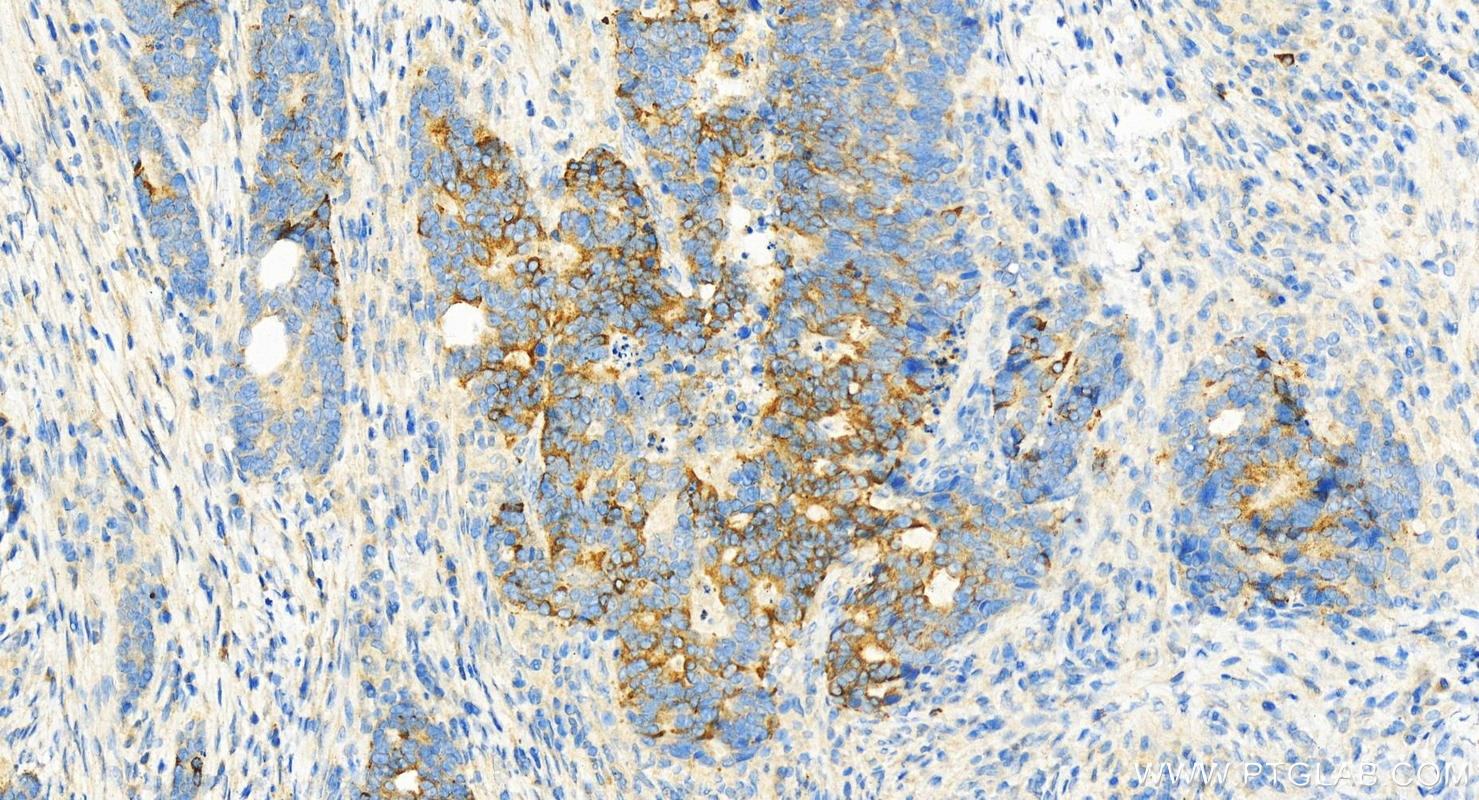 IHC staining of human stomach cancer using 14190-1-AP